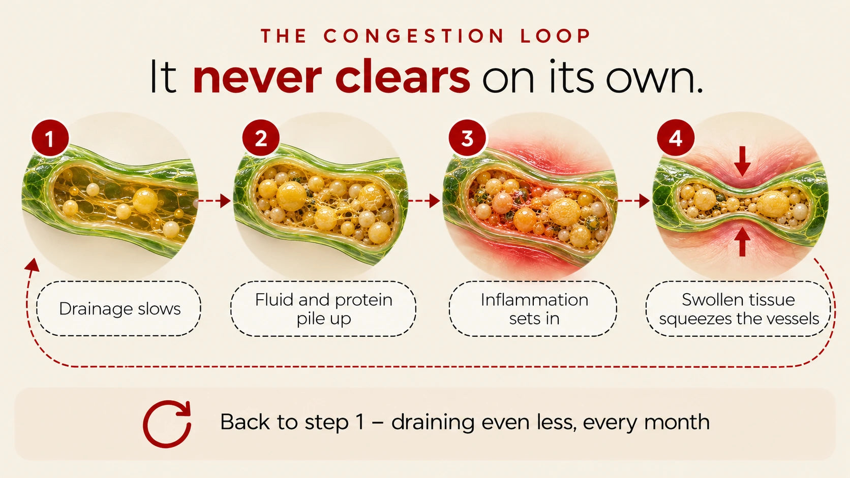 The congestion loop: drainage slows, fluid and protein pile up, inflammation sets in, swollen tissue squeezes the vessels, and it starts again.